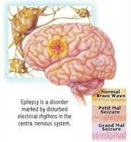 epilepsi