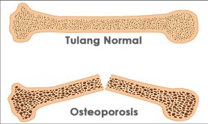 Obat Osteoporosis