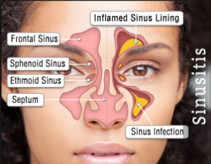 Obat Sinusitis Ampuh