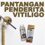 Makanan Yang Harus Dihindari Penyakit Vitiligo